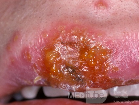 Early Herpes Simplex Upper Lip [Closer View]
