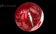 New Technique for Endoscopic Adenoidectomy by Microdebrider (Shaver)