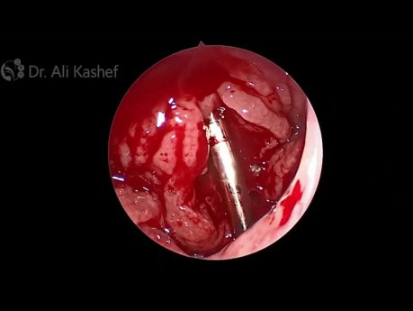New Technique for Endoscopic Adenoidectomy by Microdebrider (Shaver)