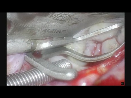 Minimally Invasive Removal of a Left Atrial Mass