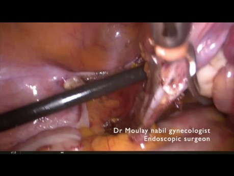 Total Laparoscopic Hysterectomy for Resident