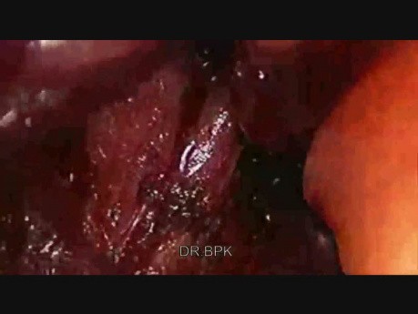 Median Arcuate Ligament Release