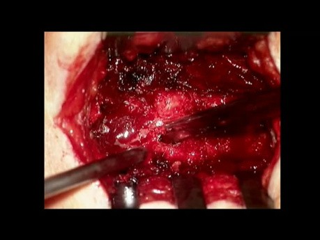Stenosis of the Thoracic Spine
