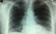 Gastrointestinal Perforation