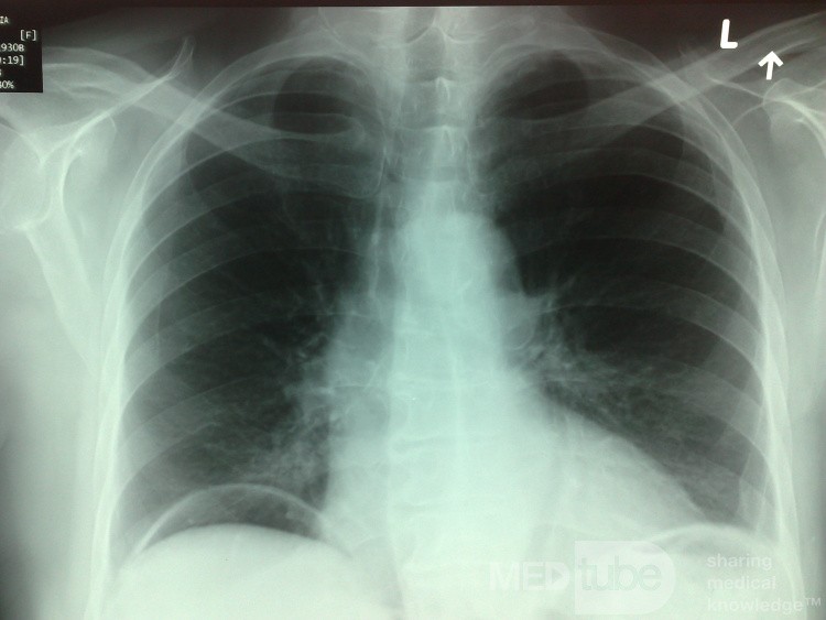 Gastrointestinal Perforation