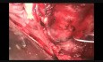 Repair of Uncomplicated Type A Dissection