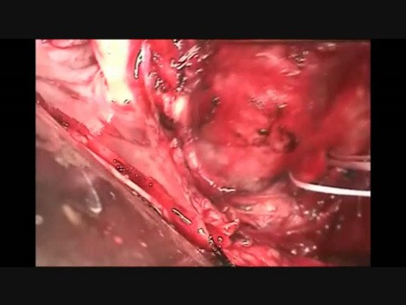 Repair of Uncomplicated Type A Dissection