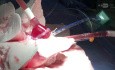 Ex-Vivo Lung Perfusion with Usage of 10 Degrees Centigrade Instead of Classic One 