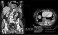 Incarcerated Thoracic Stomach