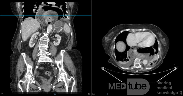Incarcerated Thoracic Stomach