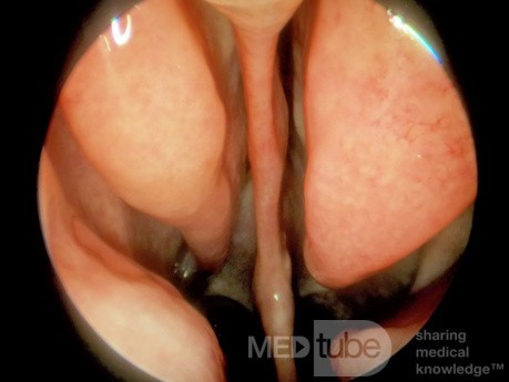 Subtotal Nasal Septal Perforation