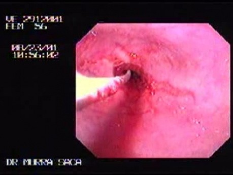 Reflux Esophagitis & Esophageal Stricture - Baloon Dilation
