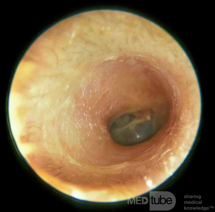 The Bony External Auditory Canal