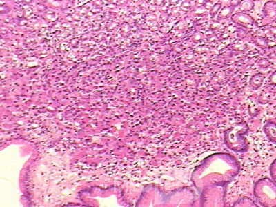 Small Gastric Adenocarcinoma of the Diffuse Ring Cell (4 of 19)