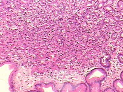 Small Gastric Adenocarcinoma of the Diffuse Ring Cell (4 of 19)