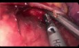 Uniportal VATS Advanced Lymph Node Dissection: Non Grasping Technique (Full Video)