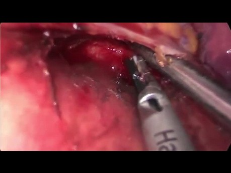 Uniportal VATS Advanced Lymph Node Dissection: Non Grasping Technique (Full Video)