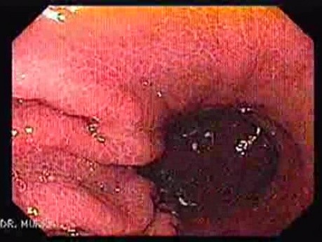 Esophageal Varices - Endoscopy (5 of 5)