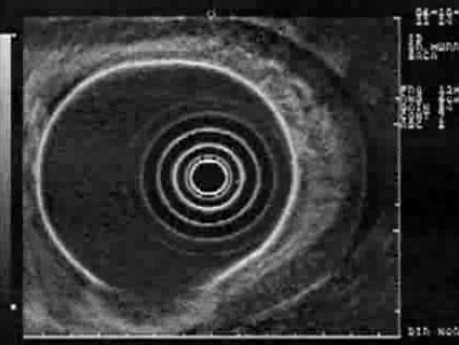 Scirrhous Gastric Carcinoma - Endoscopic Ultrasonography (10 0f 15)