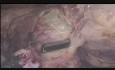 Laparoscopic Myomectomy in Case of Anterior Wall Fibroid