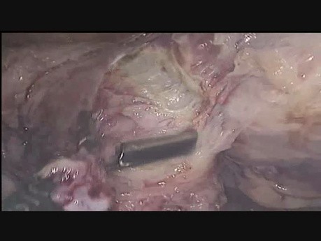 Laparoscopic Myomectomy in Case of Anterior Wall Fibroid