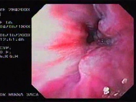 Banding of Esophageal Varices - Varices at the Cardias