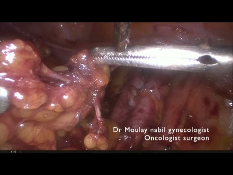 Pelvic lymphadenectomy ( right side)