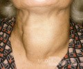 Large Thyroid Goiter [anterior view]