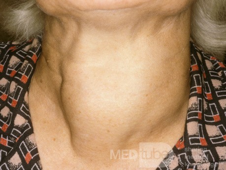 Large Thyroid Goiter [anterior view]