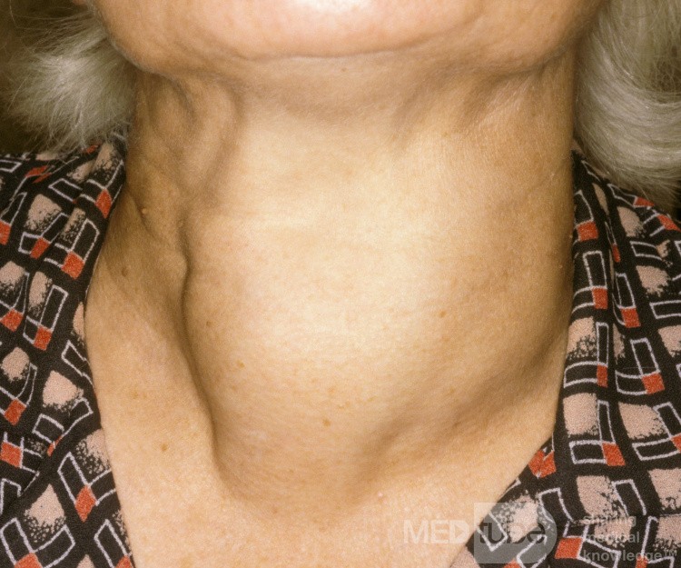 Large Thyroid Goiter [anterior view]