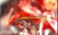 Acoustic Schwannoma -micro surgical excision- Preservation of Facial Nerve