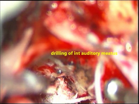 Acoustic Schwannoma -micro surgical excision- Preservation of Facial Nerve