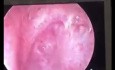 Acquired Subglottic Stenosis