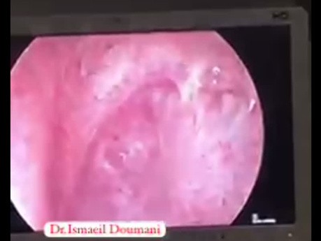 Acquired Subglottic Stenosis