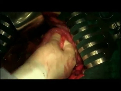 Radical transthoracic esophagectomy for cancer with 2F lymphadenectomy (modified I.Lewis procedure).
