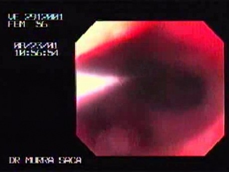 Reflux Esophagitis & Esophageal Stricture - Baloon Dilation Outcome