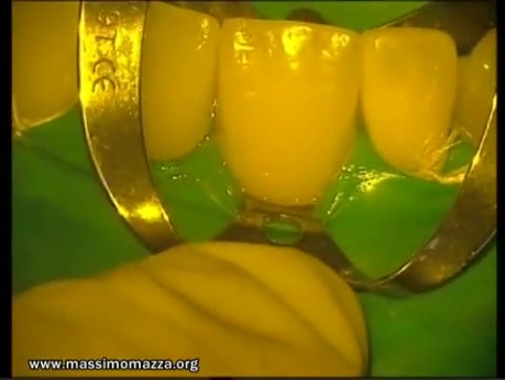 Ceramic Veneers Adhesive Cementation (4/4)