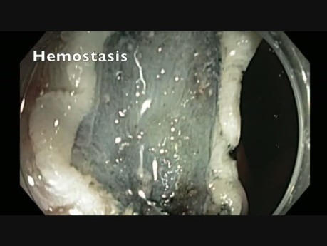 Colonoscopy - Transverse Colon - Giant Pedunculated Polyp - EMR