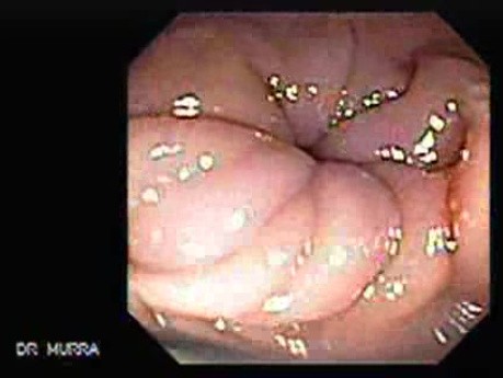 Cap Polyposis (7 of 7)