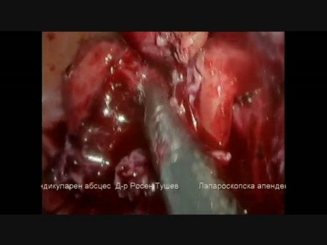 Laparoscopic Appendectomy For Gangrenous Appendicitis