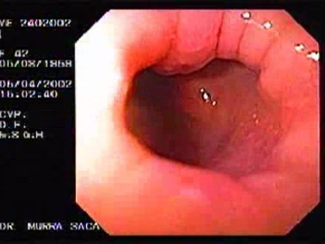 Crohn's Disease - Endoscopy (28 of 28)