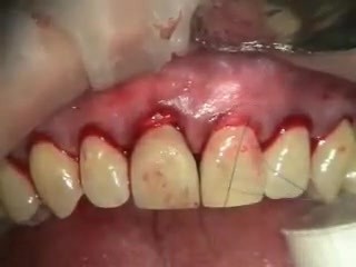 Old Crown Margin Makeover