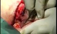 Modified Karydakis Pilonidal Surgery