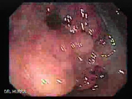 Rectal Adenocarcinoma - Colonoscopy (1 of 8)