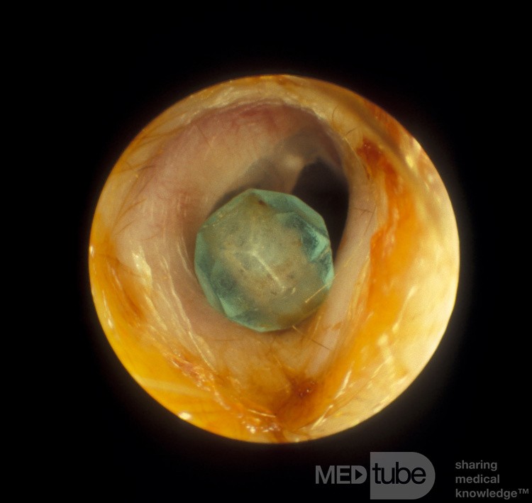 Foreign Body Ear Canal
