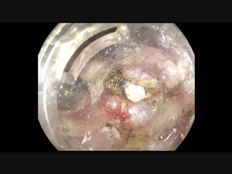 Difficult ESD – Recurrent Rectal Adenoma