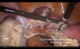 15 mn Laparoscopic Supra Cervical Hysterectomy