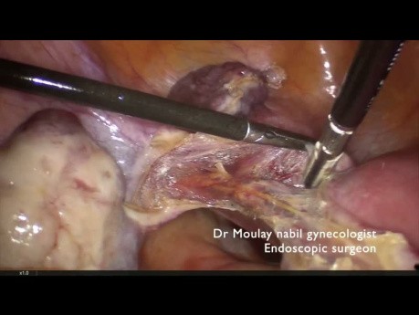15 mn Laparoscopic Supra Cervical Hysterectomy