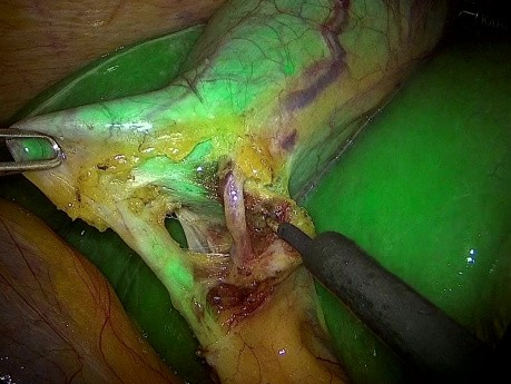 Laproscopic Cholocystectomy Using Intraoperative ICG Fluorescent Cholangiography