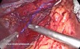 Esophageal Lengthening in Hiatal Hernia Repair – Vagal Nerve Release Technique (Avoiding Collis)
